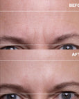 Forehead Wrinkle Patches