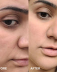 Self-Dissolving Microneedle Patches