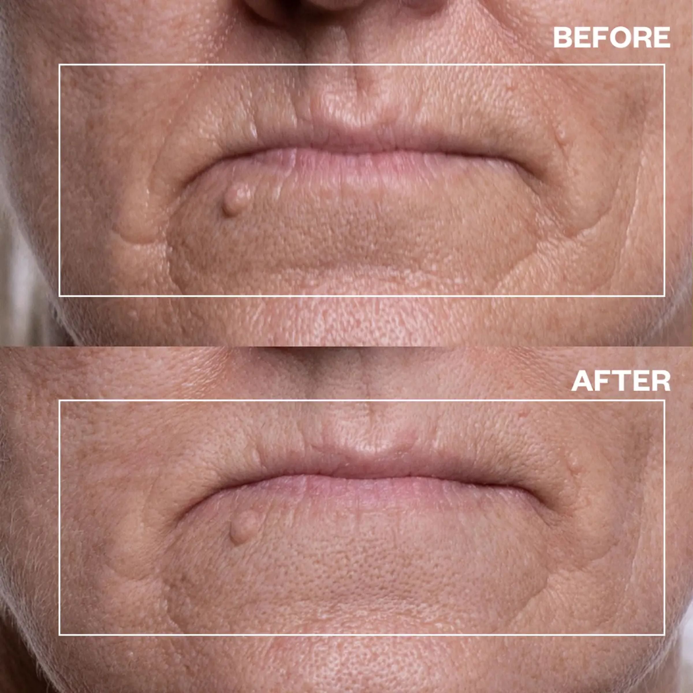 Mouth &amp; Lip Wrinkle Patches