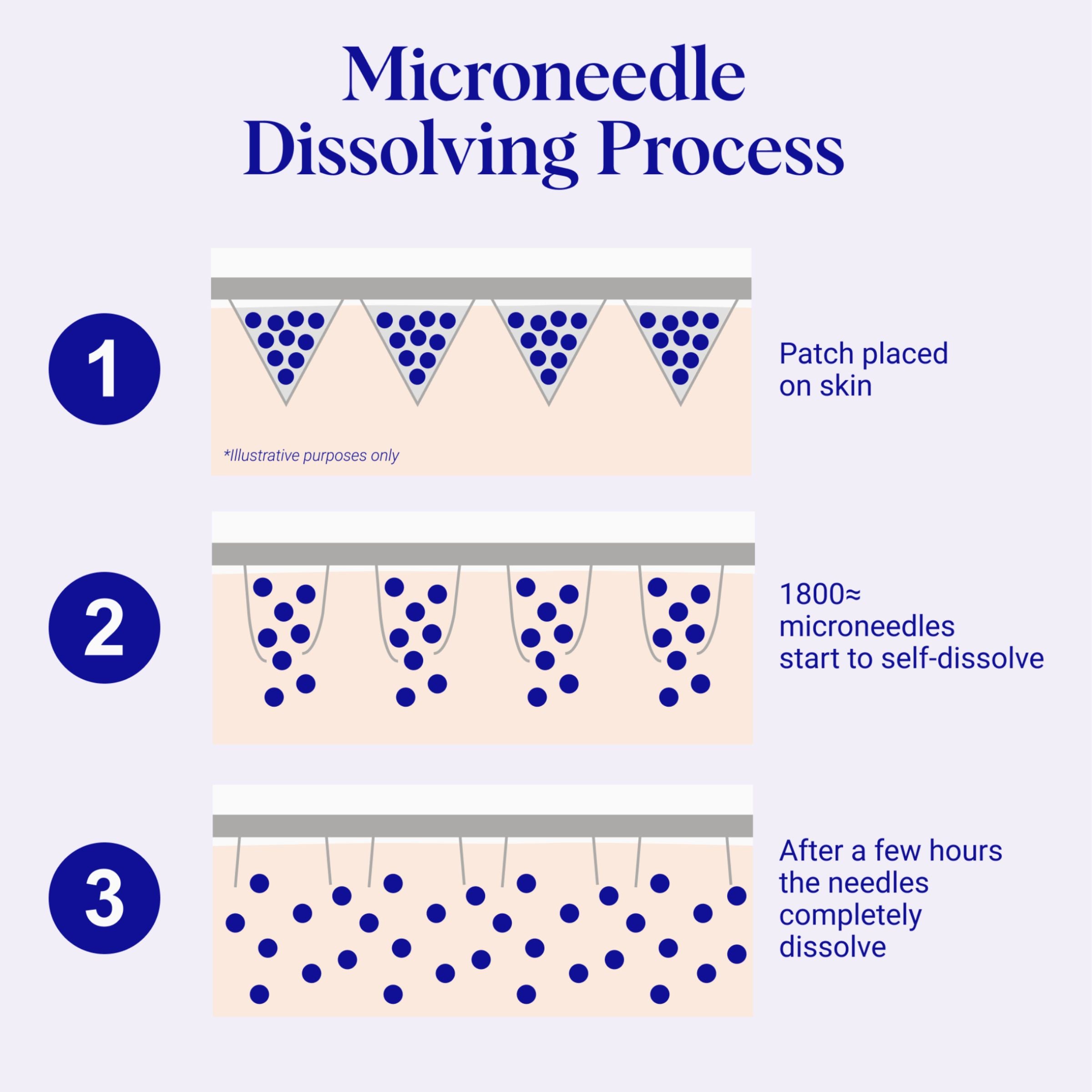 Self-Dissolving Microneedle Patches